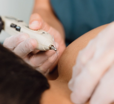 Fisioterapeuta aplicando tratamiento de fisioterapia invasiva con agujas