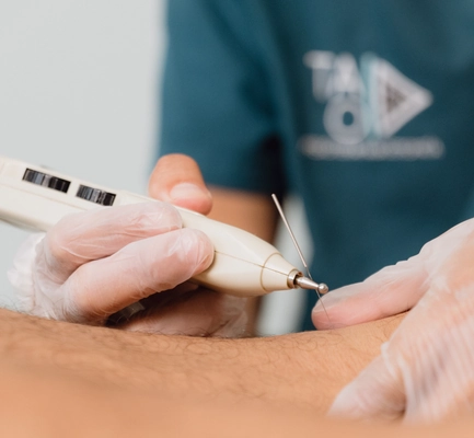 Tecnica de neuroacupuntura en TAO Fisioterapia en Jerez de la Frontera