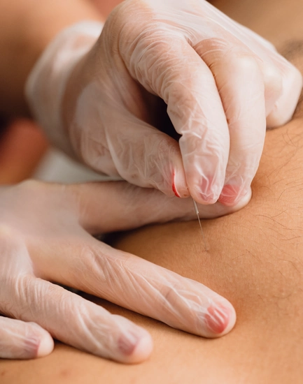 Terapia de Punción Seca en TAO Fisioterapia Jerez de la Frontera